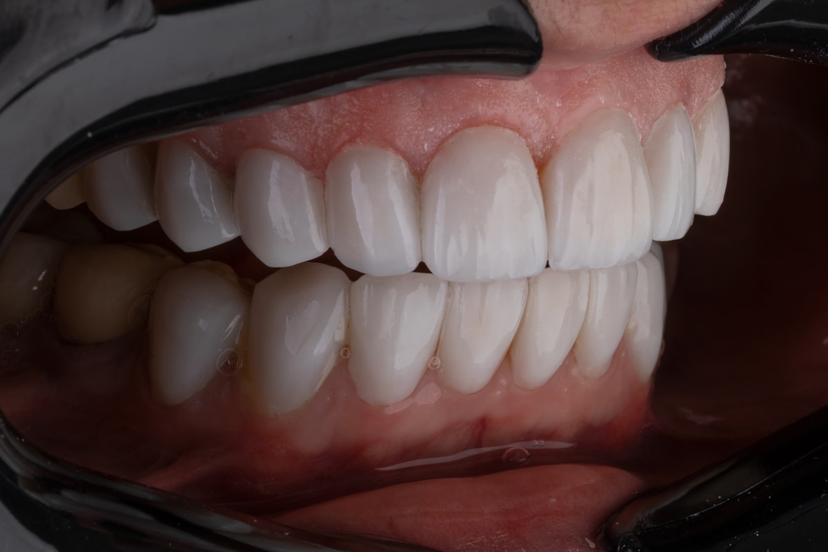 Resultado de estética dental y diseño de sonrisa